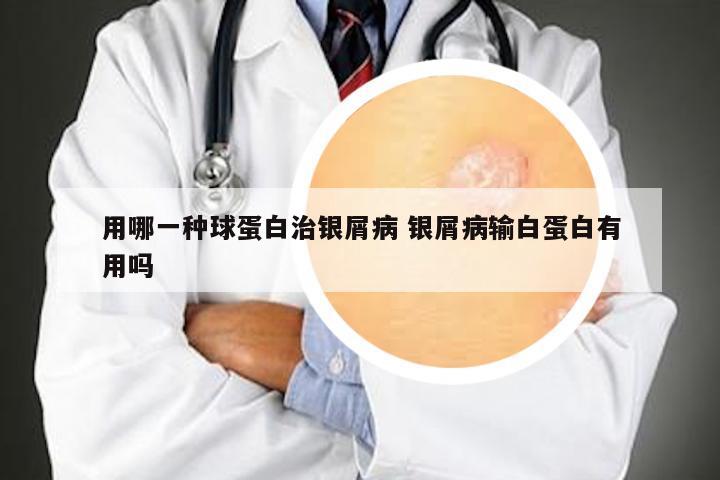 用哪一种球蛋白治银屑病 银屑病输白蛋白有用吗