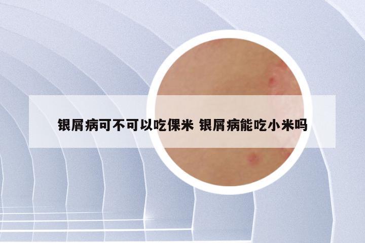 银屑病可不可以吃倮米 银屑病能吃小米吗