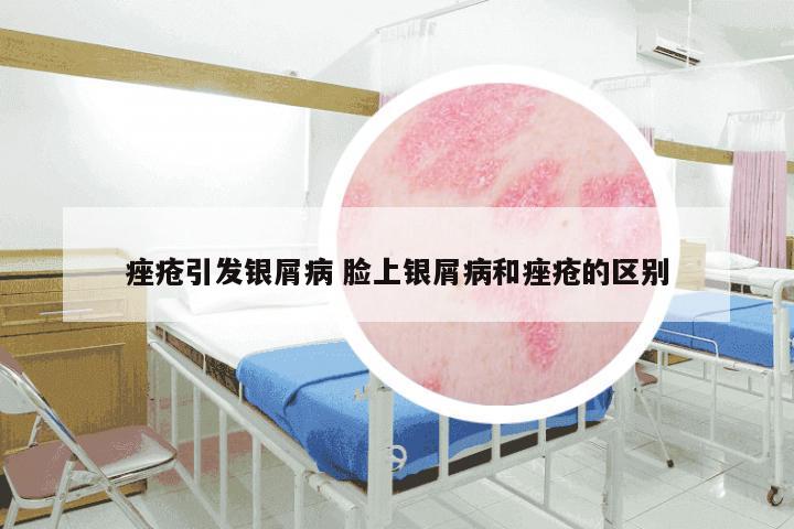 痤疮引发银屑病 脸上银屑病和痤疮的区别