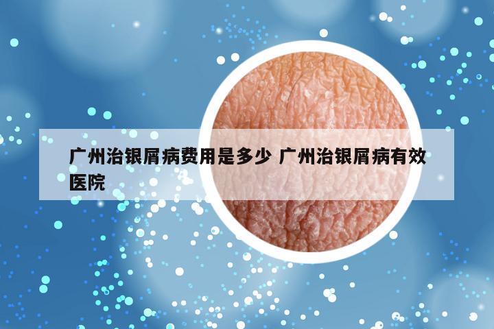 广州治银屑病费用是多少 广州治银屑病有效医院