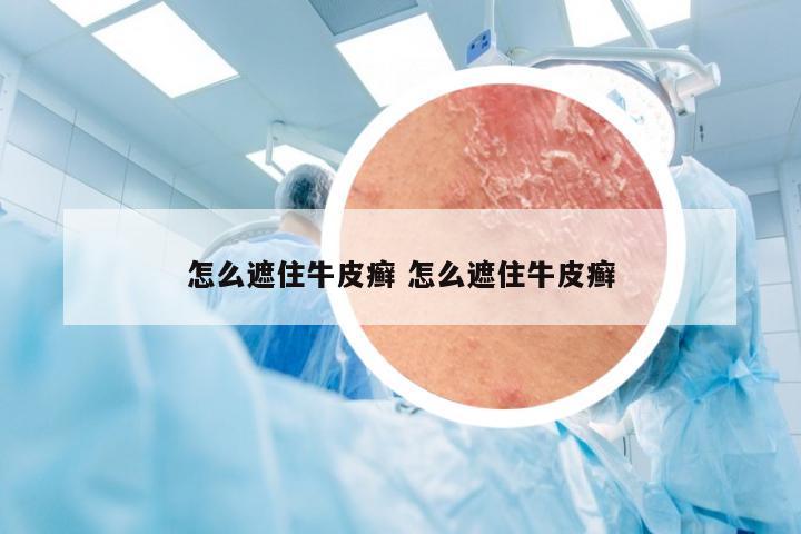 怎么遮住牛皮癣 怎么遮住牛皮癣