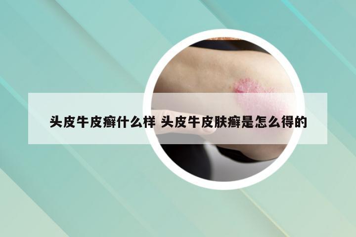 头皮牛皮癣什么样 头皮牛皮肤癣是怎么得的