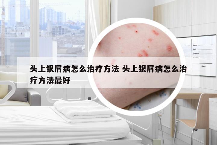 头上银屑病怎么治疗方法 头上银屑病怎么治疗方法最好