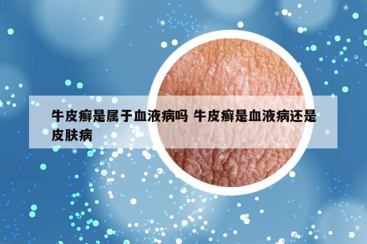 牛皮癣是属于血液病吗 牛皮癣是血液病还是皮肤病