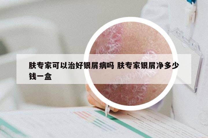 肤专家可以治好银屑病吗 肤专家银屑净多少钱一盒