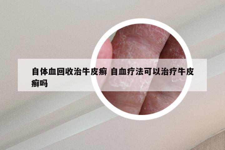 自体血回收治牛皮癣 自血疗法可以治疗牛皮癣吗