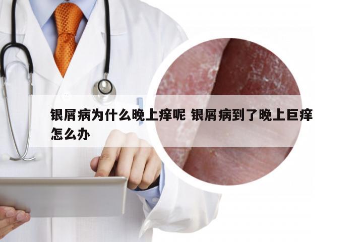 银屑病为什么晚上痒呢 银屑病到了晚上巨痒怎么办