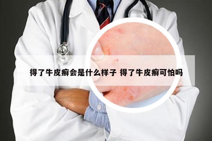 得了牛皮癣会是什么样子 得了牛皮癣可怕吗