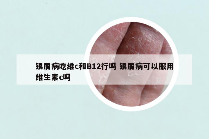 银屑病吃维c和B12行吗 银屑病可以服用维生素c吗