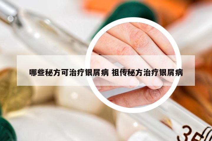 哪些秘方可治疗银屑病 祖传秘方治疗银屑病