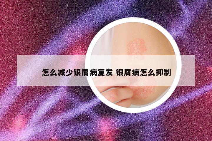 怎么减少银屑病复发 银屑病怎么抑制