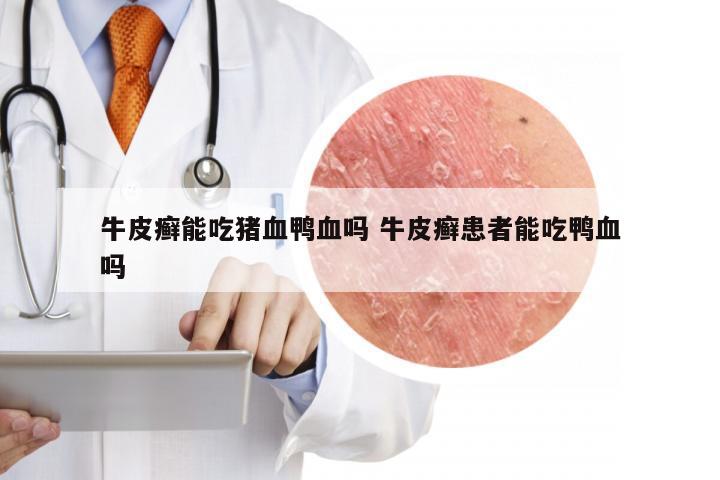 牛皮癣能吃猪血鸭血吗 牛皮癣患者能吃鸭血吗
