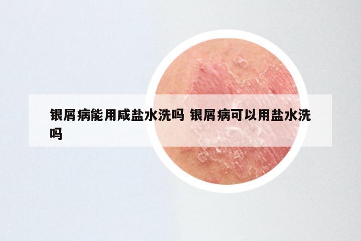 银屑病能用咸盐水洗吗 银屑病可以用盐水洗吗