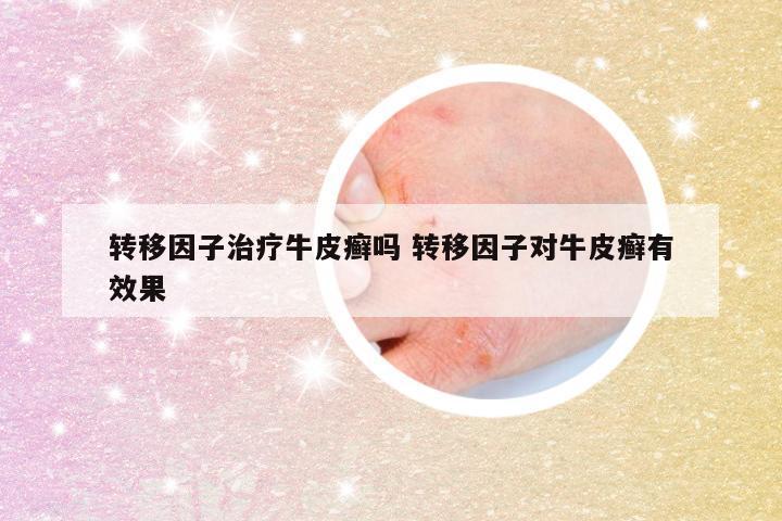 转移因子治疗牛皮癣吗 转移因子对牛皮癣有效果