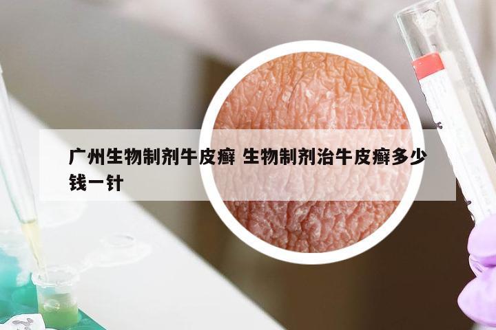 广州生物制剂牛皮癣 生物制剂治牛皮癣多少钱一针
