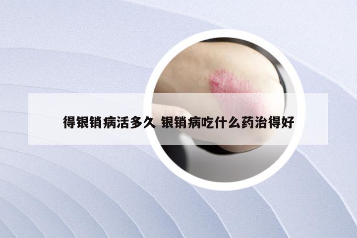得银销病活多久 银销病吃什么药治得好