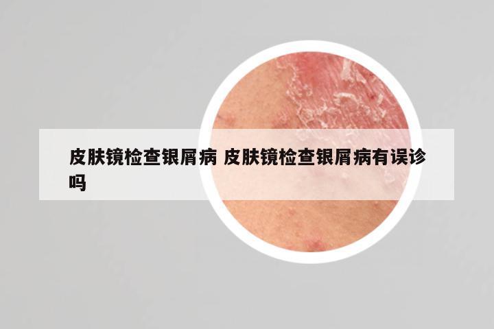 皮肤镜检查银屑病 皮肤镜检查银屑病有误诊吗
