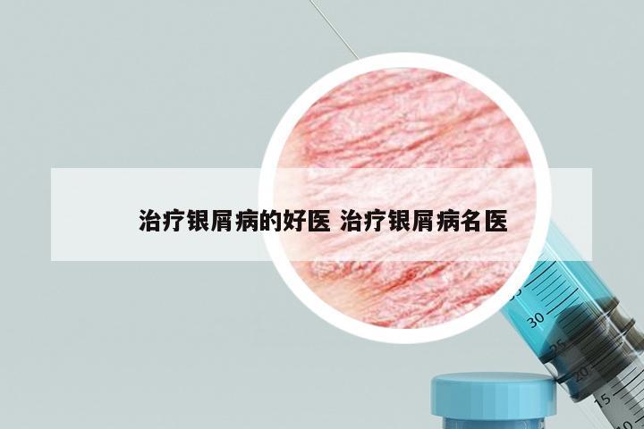 治疗银屑病的好医 治疗银屑病名医