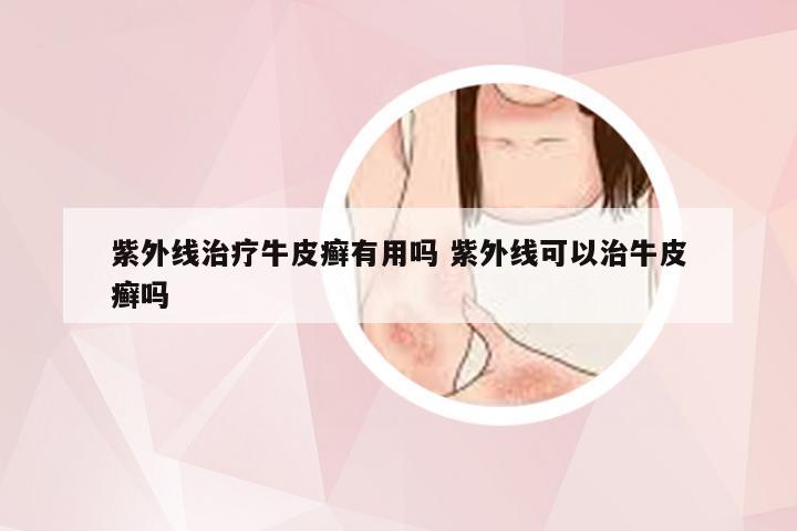 紫外线治疗牛皮癣有用吗 紫外线可以治牛皮癣吗