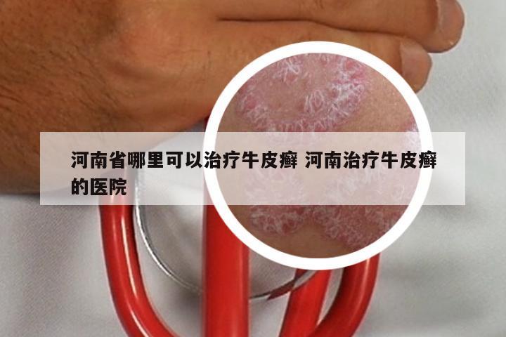 河南省哪里可以治疗牛皮癣 河南治疗牛皮癣的医院