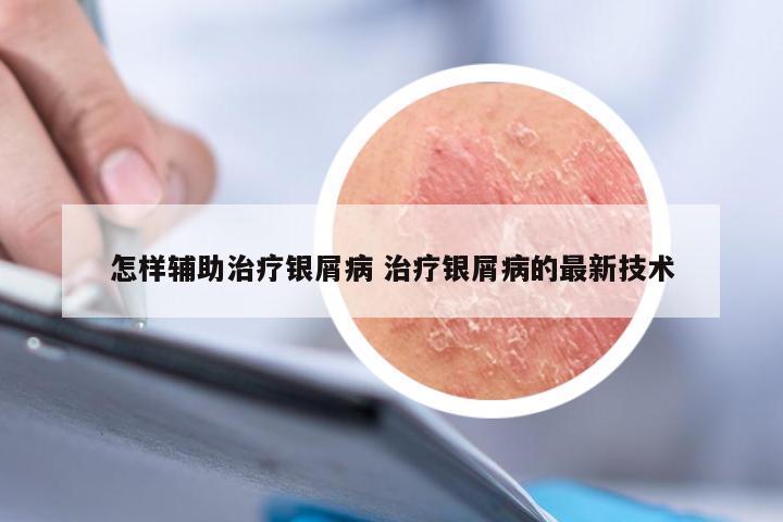 怎样辅助治疗银屑病 治疗银屑病的最新技术