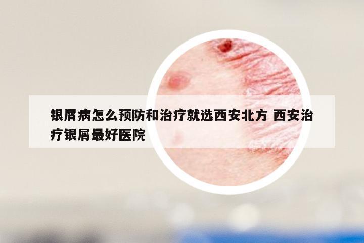 银屑病怎么预防和治疗就选西安北方 西安治疗银屑最好医院