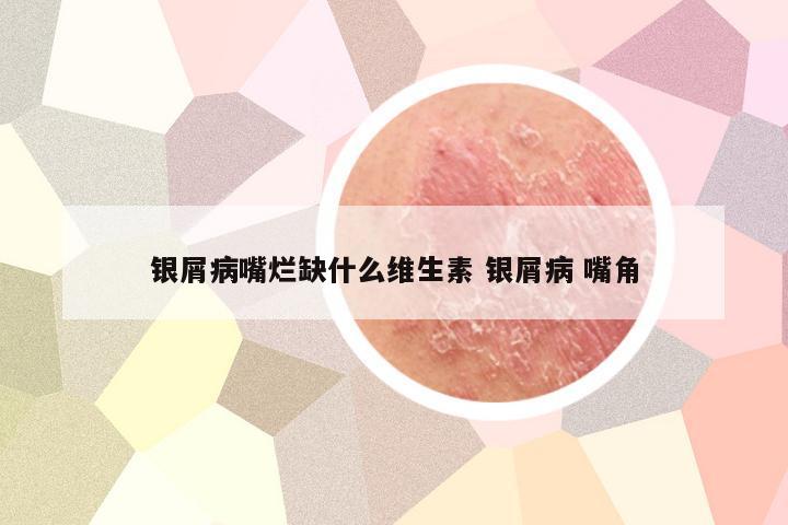 银屑病嘴烂缺什么维生素 银屑病 嘴角