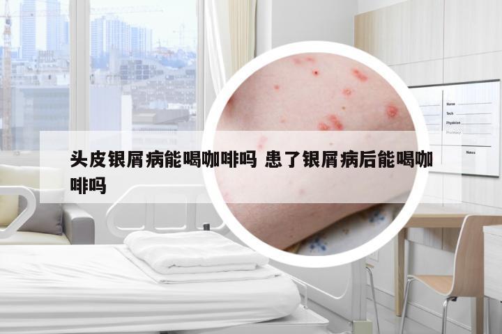头皮银屑病能喝咖啡吗 患了银屑病后能喝咖啡吗
