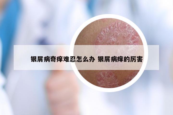 银屑病奇痒难忍怎么办 银屑病痒的厉害