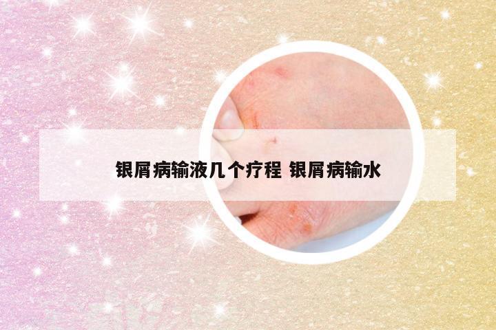 银屑病输液几个疗程 银屑病输水