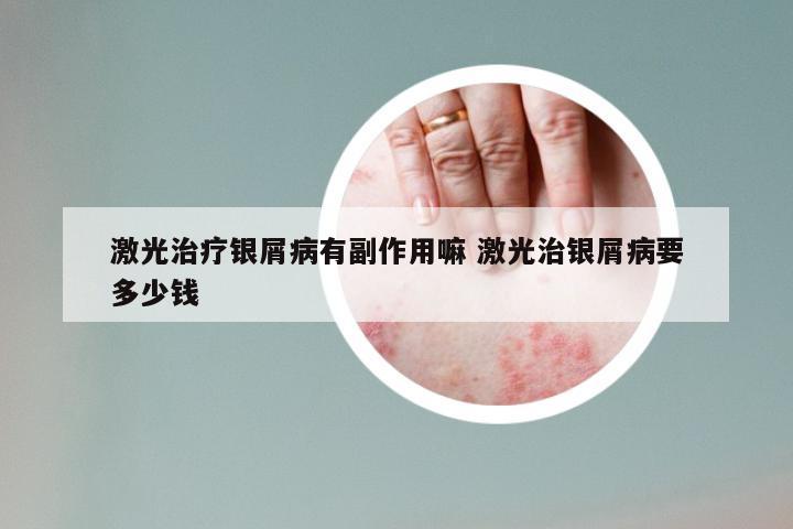 激光治疗银屑病有副作用嘛 激光治银屑病要多少钱