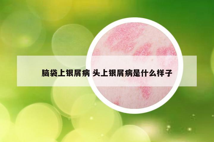 脑袋上银屑病 头上银屑病是什么样子