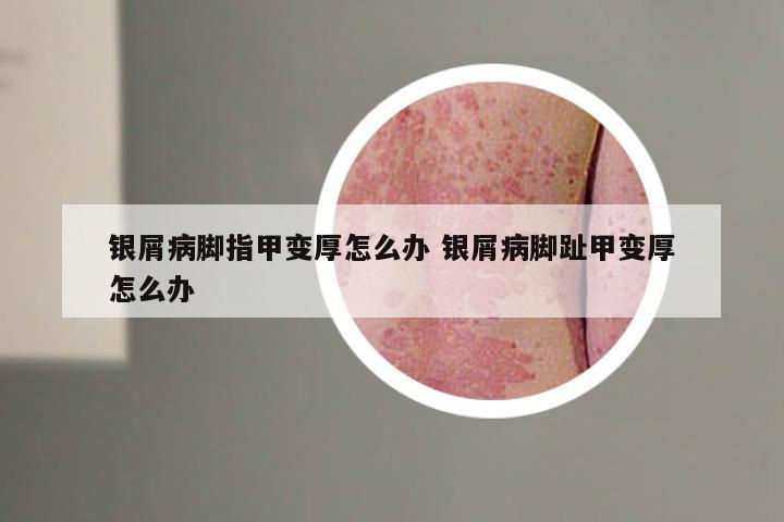 银屑病脚指甲变厚怎么办 银屑病脚趾甲变厚怎么办