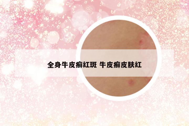 全身牛皮癣红斑 牛皮癣皮肤红