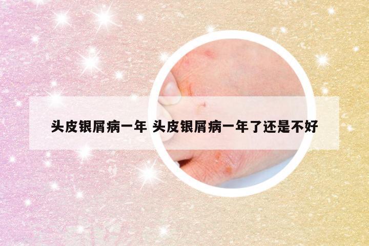 头皮银屑病一年 头皮银屑病一年了还是不好