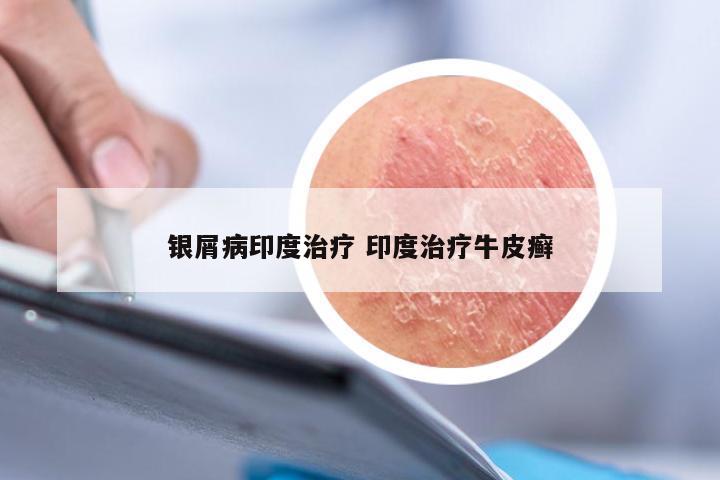 银屑病印度治疗 印度治疗牛皮癣
