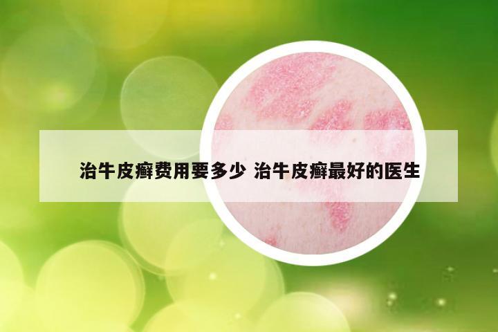 治牛皮癣费用要多少 治牛皮癣最好的医生