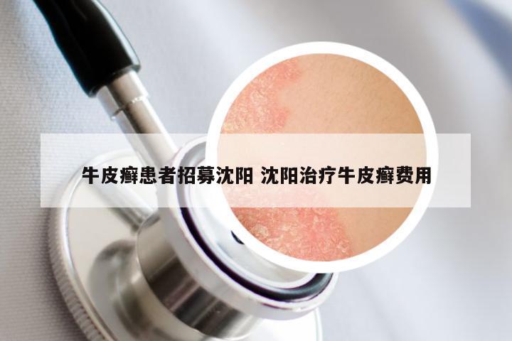 牛皮癣患者招募沈阳 沈阳治疗牛皮癣费用