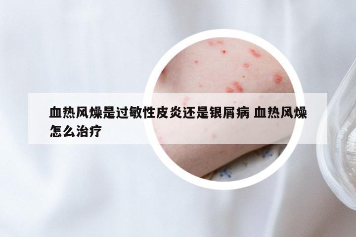 血热风燥是过敏性皮炎还是银屑病 血热风燥怎么治疗