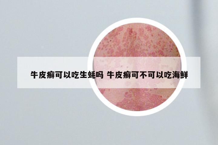牛皮癣可以吃生蚝吗 牛皮癣可不可以吃海鲜