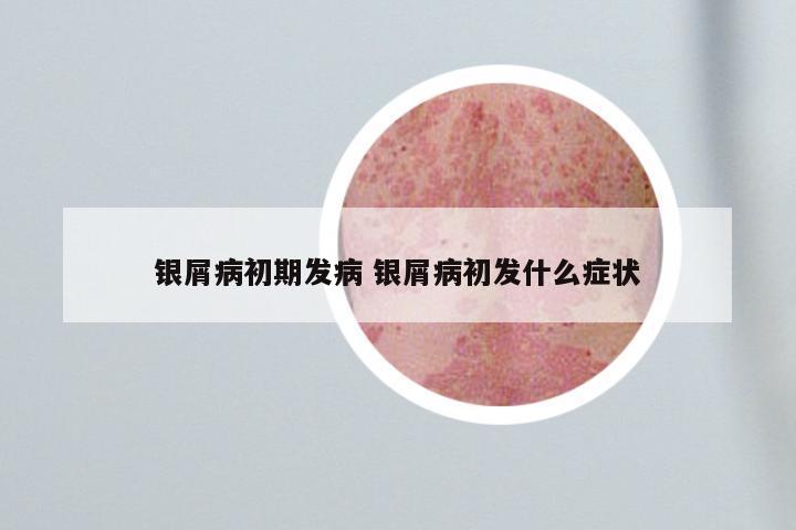 银屑病初期发病 银屑病初发什么症状