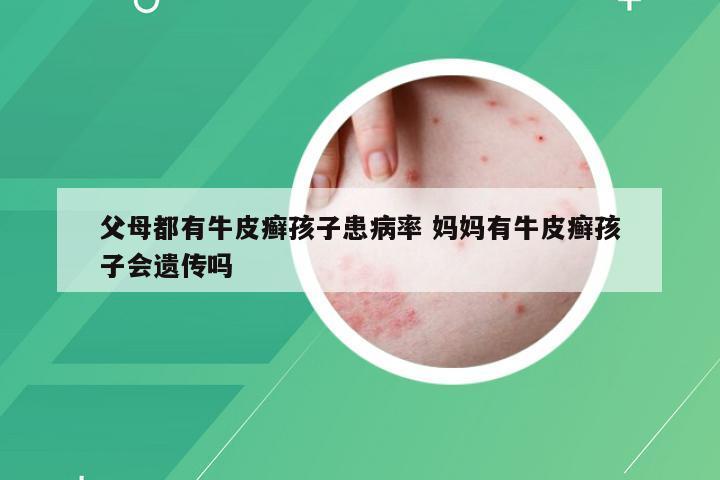 父母都有牛皮癣孩子患病率 妈妈有牛皮癣孩子会遗传吗