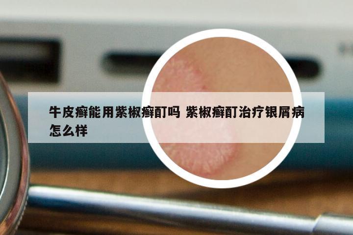 牛皮癣能用紫椒癣酊吗 紫椒癣酊治疗银屑病怎么样