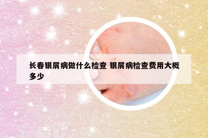长春银屑病做什么检查 银屑病检查费用大概多少