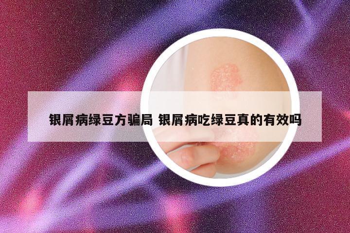 银屑病绿豆方骗局 银屑病吃绿豆真的有效吗