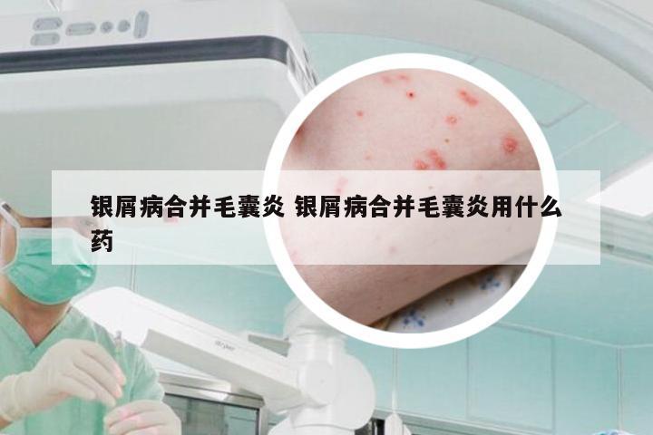 银屑病合并毛囊炎 银屑病合并毛囊炎用什么药