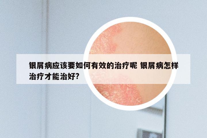 银屑病应该要如何有效的治疗呢 银屑病怎样治疗才能治好?