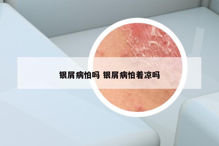 银屑病怕吗 银屑病怕着凉吗