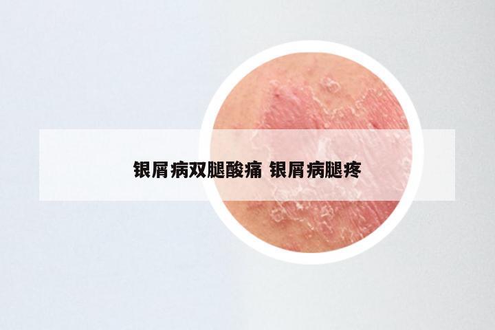 银屑病双腿酸痛 银屑病腿疼