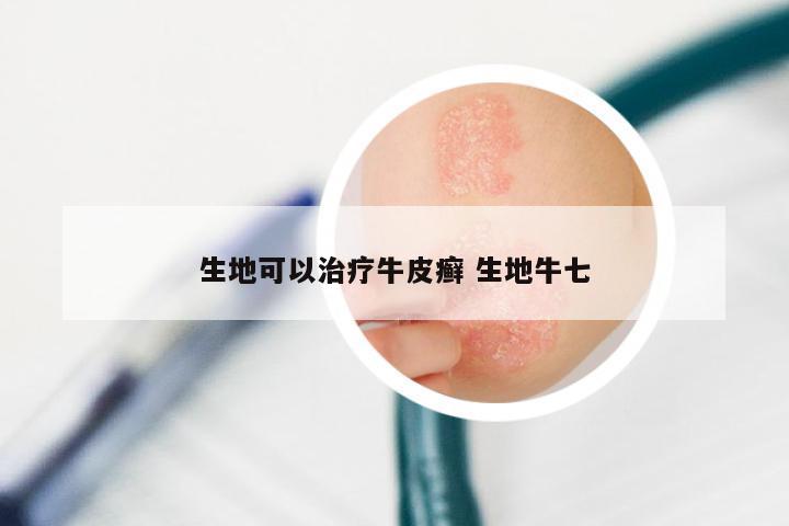 生地可以治疗牛皮癣 生地牛七